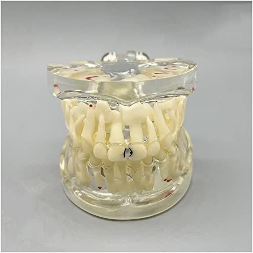 Модел детски зъби KH66ZKY Typodont Модел на Млечно-Постоянно Ивичест Кариес - Идеална Образователна Технология Модел зъби за деца